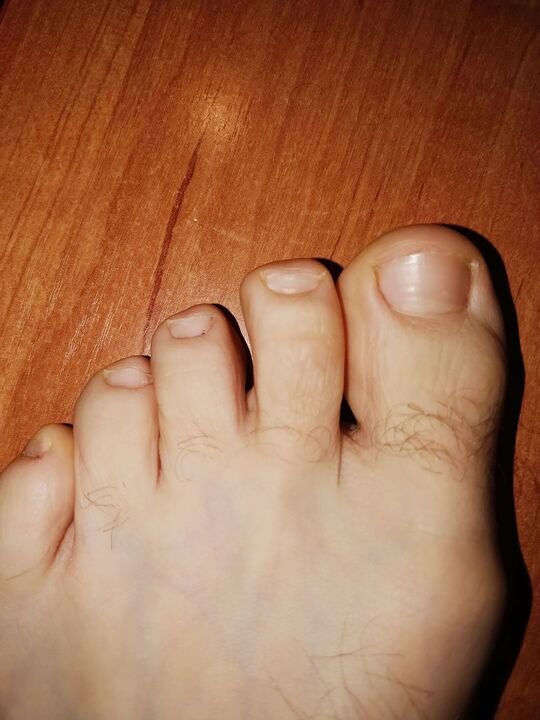 Piedi senza fungo dopo aver applicato la crema brand esodermin cr.